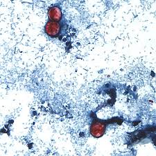 Massive cyclosporiasis outbreak linked to four more states | C.D.C. Expands Cyclospora Outbreak L…
